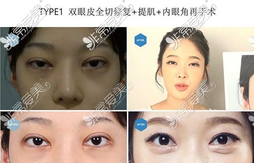 韩国soonplus整形外科双眼皮宽改窄修复案例