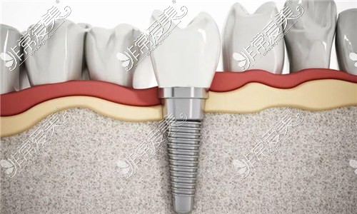 种植牙示意图
