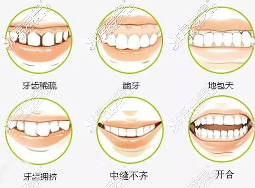 牙齿畸形分类