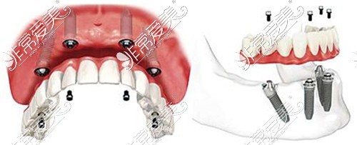 宁波全口种植哪家医院能做？全口种植牙一般需要种多少颗