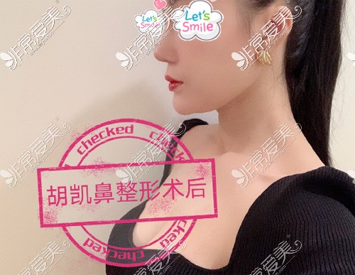 胡凱醫(yī)生隆鼻效果