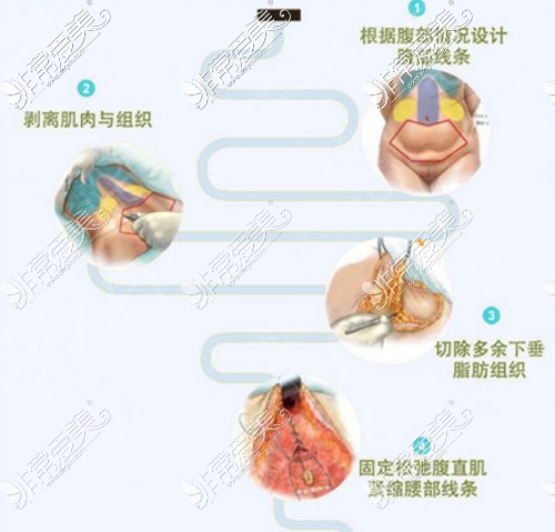 腹壁成形术手术原理展示