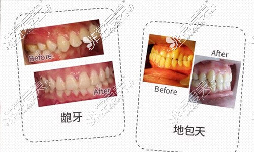 杭州牙齿矫正大概要花费多少钱？附2021年金属隐形矫正价格