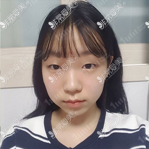 韩国一毫米双眼皮手术照片