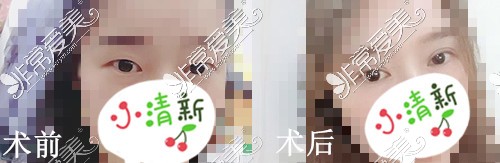 东莞华美整形双眼皮日记