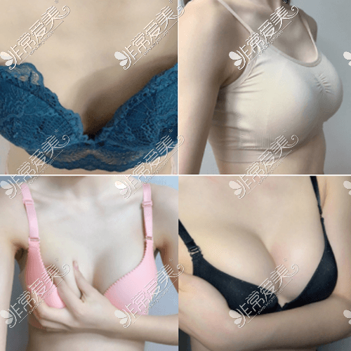 韩国原辰整形外科隆胸案例