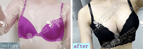 韩国普罗菲耳整形外科隆胸案例