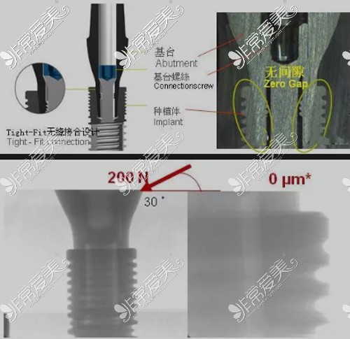 瑞士百丹特Biodente种植体特点展示