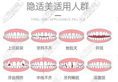 隐适美牙齿矫正适应人群