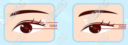 双眼皮手术改善眼睛大小的差异
