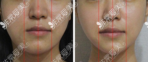 面部轮廓手术改善下颌角不对称