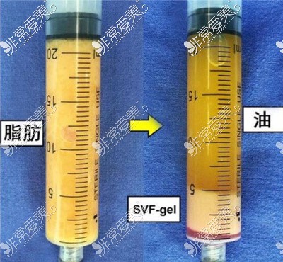 重庆哪家医院做脂肪填充好?这5家面填&脂肪丰胸效果超赞der