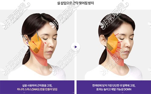 韩国Liting整形医院提升手术方法