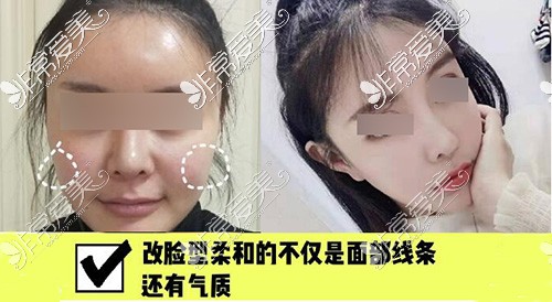 上海伊莱美磨骨怎么样？优势揭秘为何他家人气这么高！