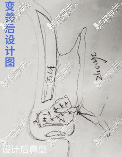 岳陽(yáng)你美整形鼻整形設(shè)計(jì)圖