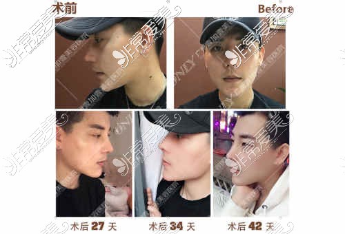 广州男生隆鼻多少钱？男生隆鼻整形医院哪家效果好