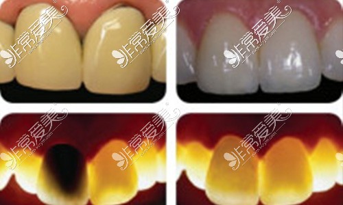烤瓷牙和全瓷牙顏色燈光對(duì)比