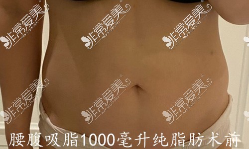 腰腹吸脂1000毫升純脂肪術(shù)前圖片