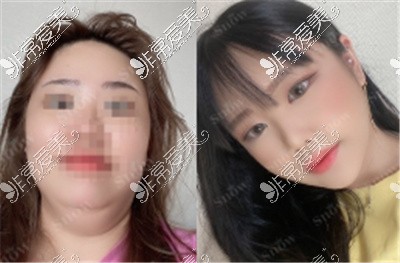 韩国SNOW医院面部吸脂案例图