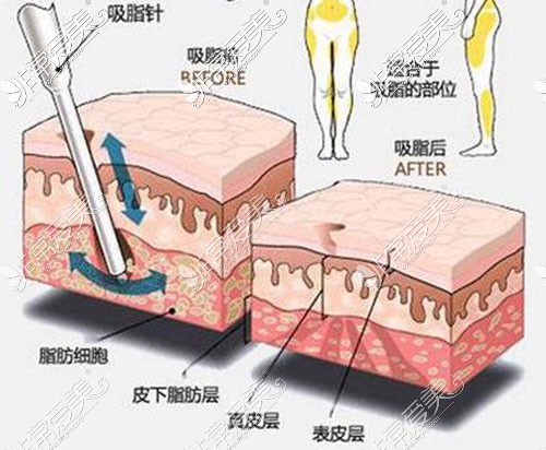 大连大腿抽脂一次多少钱?腿部吸脂减肥手术价格明细一览