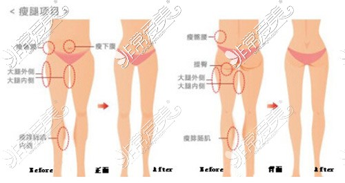 大连大腿抽脂一次多少钱?腿部吸脂减肥手术价格明细一览