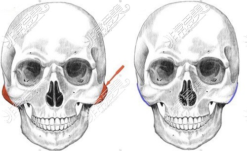 颧骨突出磨骨改善动画