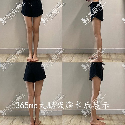 韩国365mc医院大腿吸脂术后展示照片