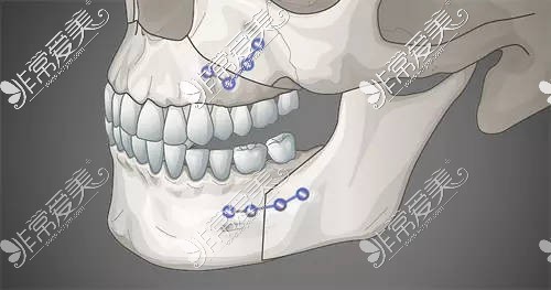 雙鄂手術(shù)