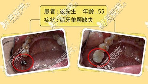 长沙牙祖口腔种植牙修复照片