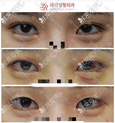 韩国来丽整形双眼皮变单眼皮案例