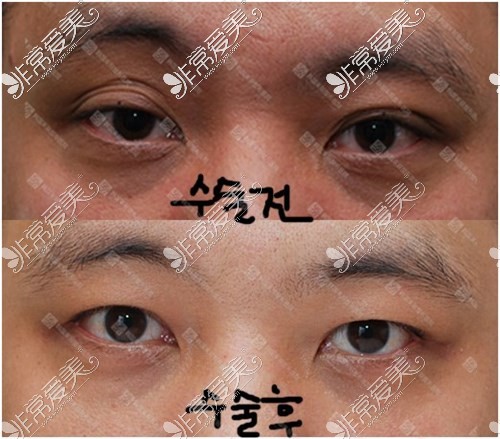 双眼皮能做成单眼皮吗?这可是韩国来丽整形特色,日记在此!
