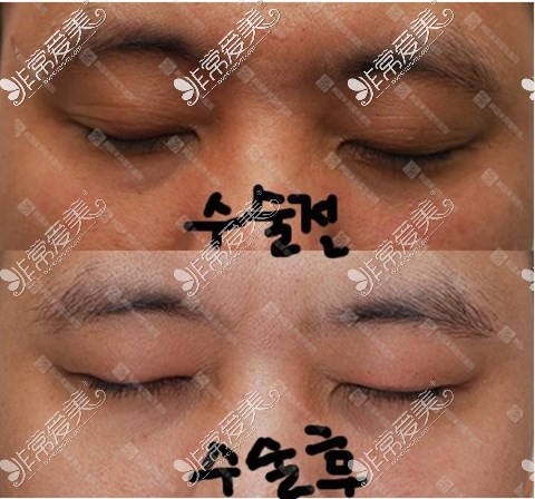 韩国来丽整形双眼皮变单眼皮案例