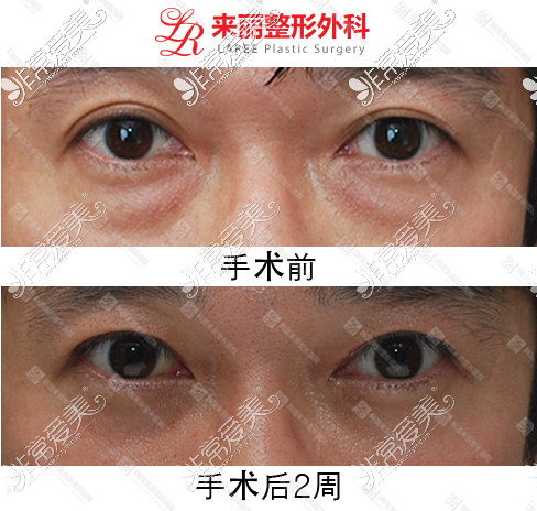 双眼皮能做成单眼皮吗?这可是韩国来丽整形特色,案例在此!