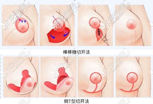 荔湾区人民医院手术方式