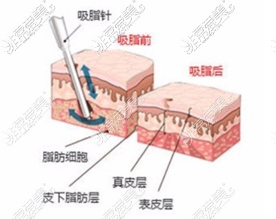 南通康美醫(yī)療美容醫(yī)院吸脂方式圖示