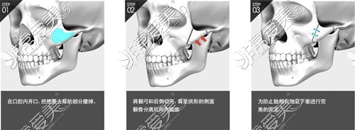 朴晟皖颧骨整形手术方式