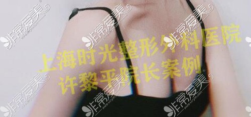 许黎平隆胸技术怎么样？分析优势还附带做胸真实案例！