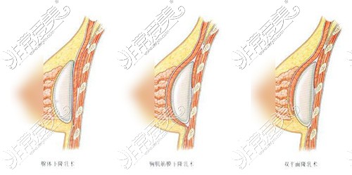 隆胸雙平面植入技術(shù)