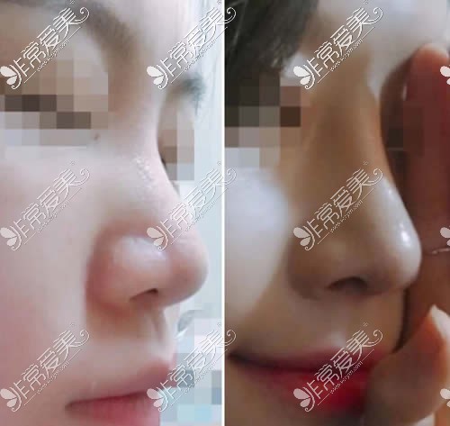韩国首尔整形外科隆鼻案例