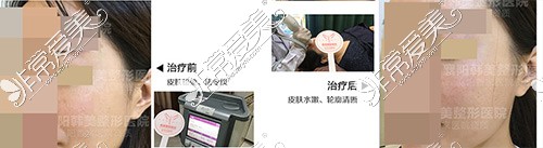 襄阳热玛吉官方认证医院公布 正规热玛吉医院谁家做的好