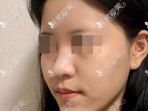 韩国优雅人自体肋骨隆鼻手术前