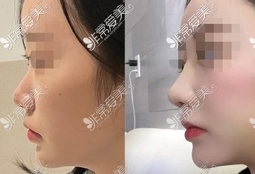 韩国优雅人隆鼻手术前后对比效果