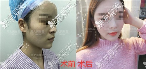 上海隆鼻医生哪个好?看看伊莱美邱文苑隆鼻能进前几?