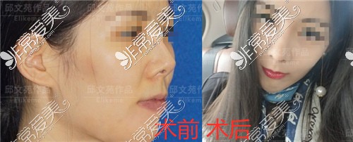 上海伊莱美整形医院邱文苑隆鼻修复