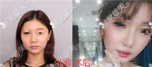 上海伊莱美整形医院邱文苑隆鼻如何