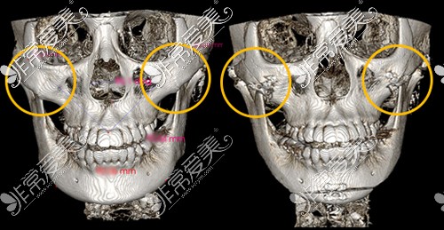 何照華醫(yī)生做顴骨縮小術(shù)后CT圖