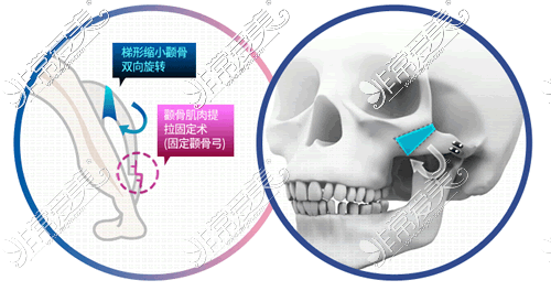 黄大勇医生做颧骨整形手术特点展示