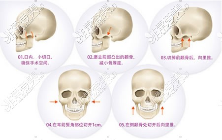 張笑天醫(yī)生做顴骨縮小卡通示意圖