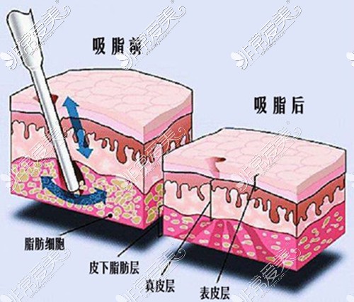 吸脂原理示意图