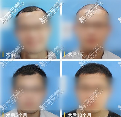 福州哪个医院看脱发更专业?盘点5家福州看脱发的正规医院